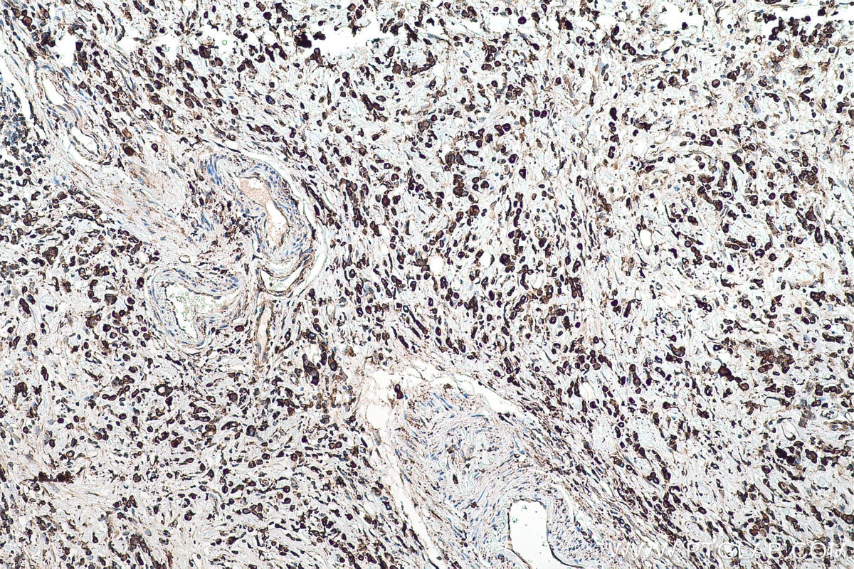 Immunohistochemical analysis of paraffin-embedded human stomach cancer tissue slide using KHC0516 (PDI/P4HB IHC Kit).