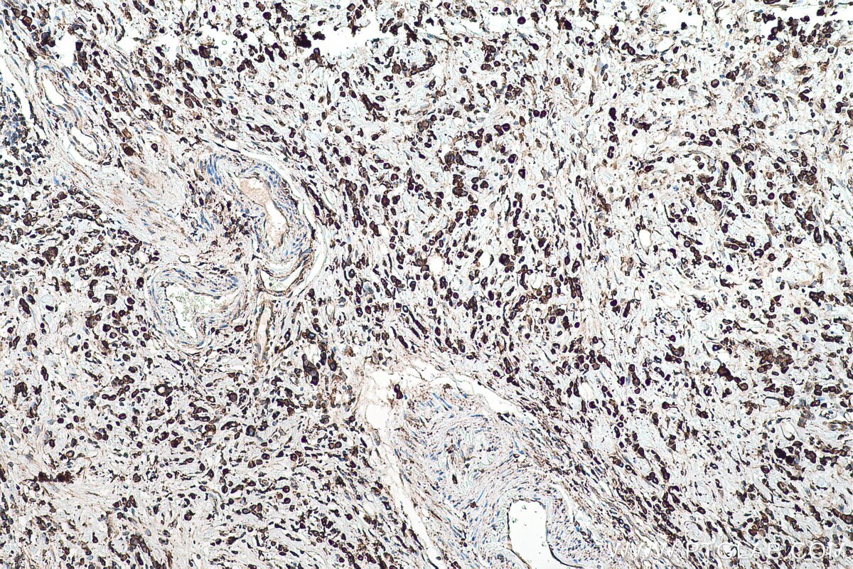 Immunohistochemical analysis of paraffin-embedded human stomach cancer tissue slide using KHC0516 (PDI/P4HB IHC Kit).