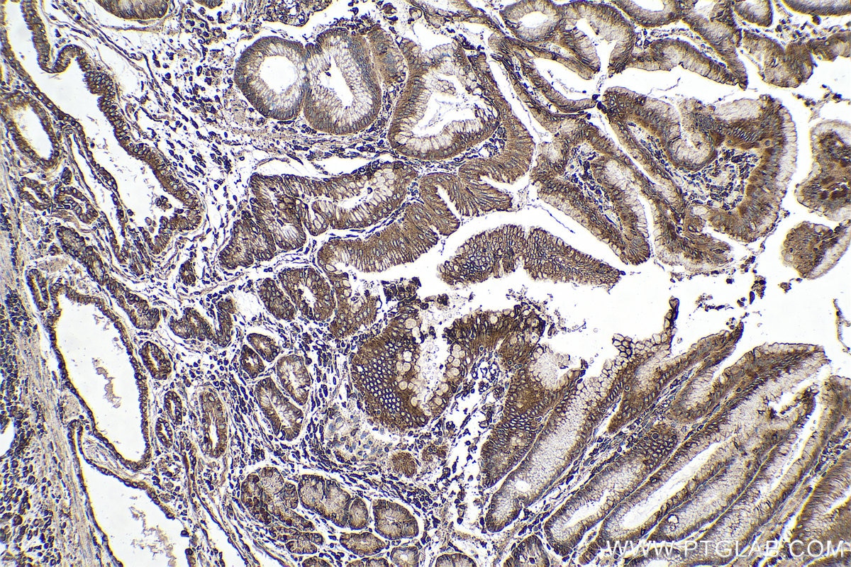 Immunohistochemical analysis of paraffin-embedded human stomach cancer tissue slide using KHC0535 (PDIA3 IHC Kit).