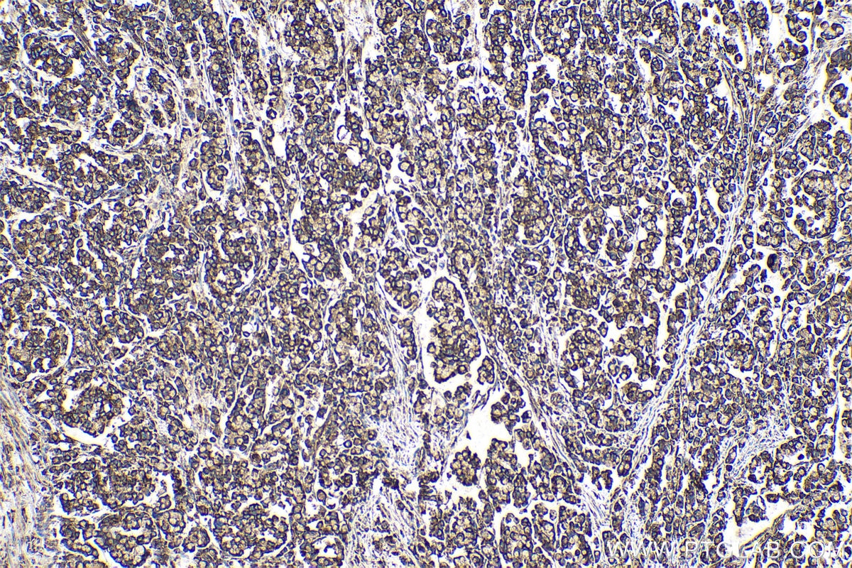 Immunohistochemical analysis of paraffin-embedded human colon cancer tissue slide using KHC0535 (PDIA3 IHC Kit).
