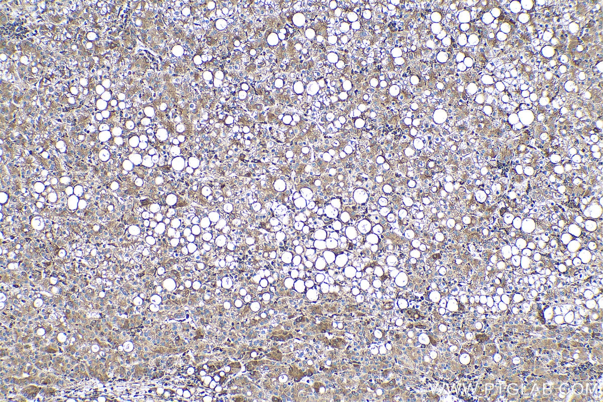 Immunohistochemical analysis of paraffin-embedded human liver cancer tissue slide using KHC0535 (PDIA3 IHC Kit).
