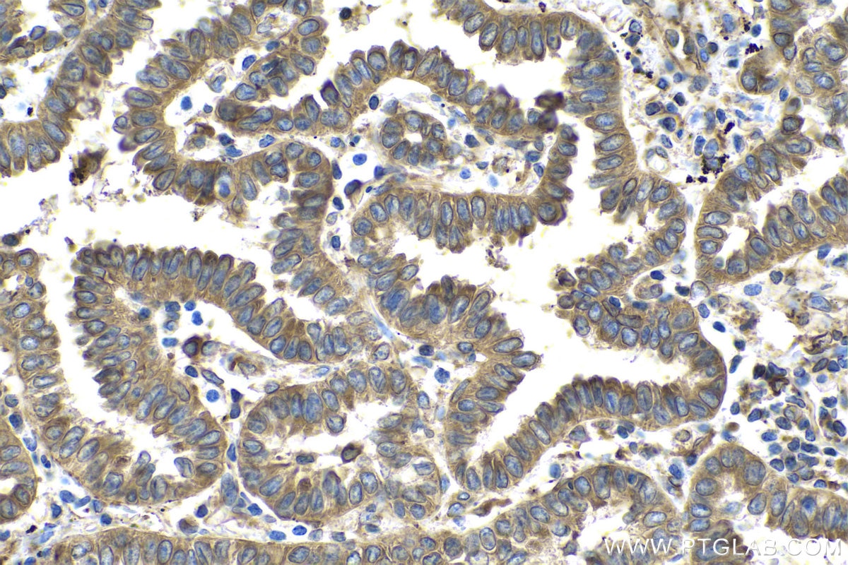 Immunohistochemical analysis of paraffin-embedded human lung cancer tissue slide using KHC0535 (PDIA3 IHC Kit).