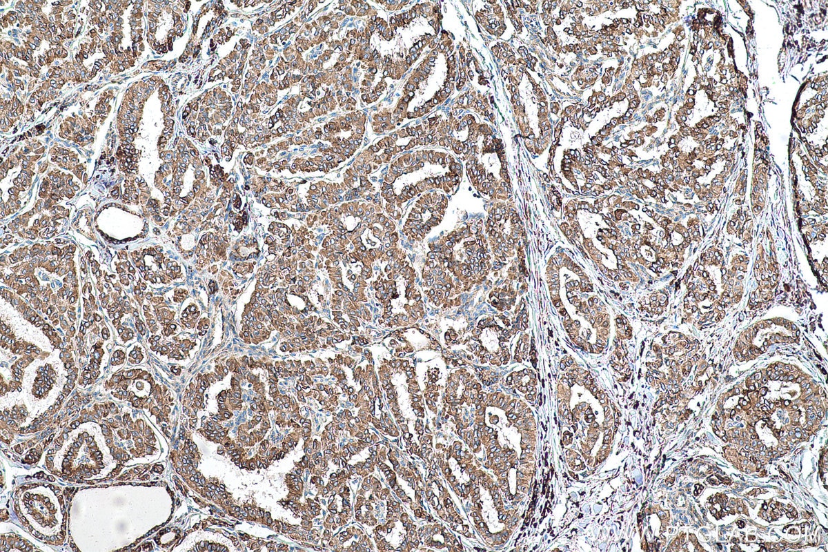 Immunohistochemical analysis of paraffin-embedded human thyroid cancer tissue slide using KHC0584 (PDIA4/ERP72 IHC Kit).