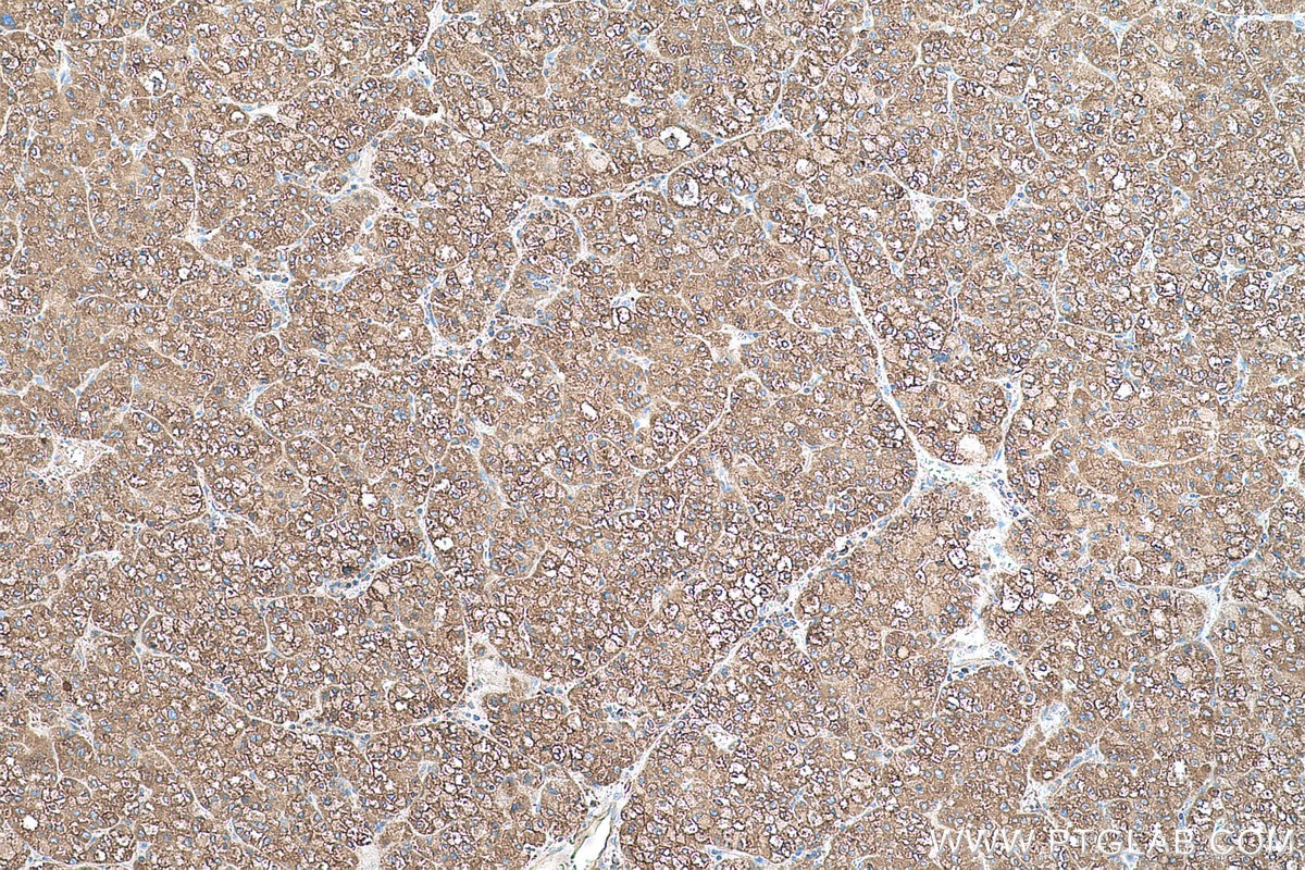 Immunohistochemical analysis of paraffin-embedded human liver cancer tissue slide using KHC0584 (PDIA4/ERP72 IHC Kit).