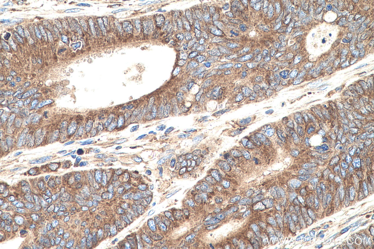 Immunohistochemical analysis of paraffin-embedded human colon cancer tissue slide using KHC0584 (PDIA4/ERP72 IHC Kit).