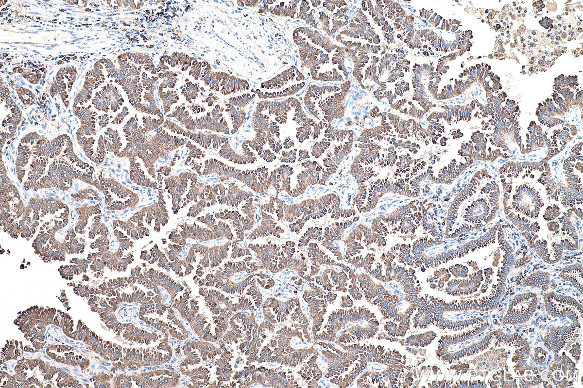 Immunohistochemical analysis of paraffin-embedded human lung cancer tissue slide using KHC0584 (PDIA4/ERP72 IHC Kit).