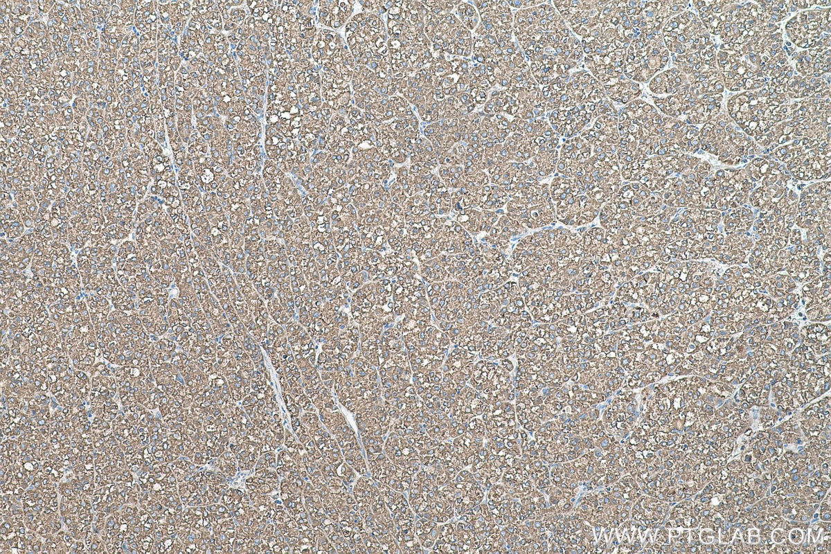 Immunohistochemical analysis of paraffin-embedded human liver cancer tissue slide using KHC0579 (PDIA6 IHC Kit).