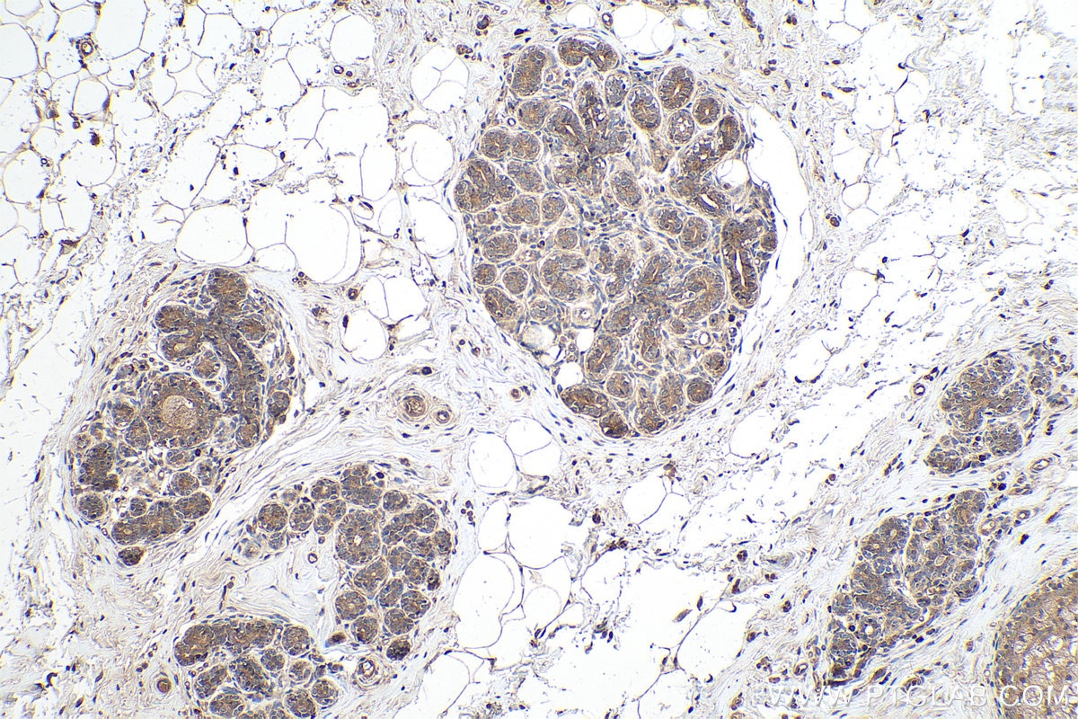 Immunohistochemical analysis of paraffin-embedded human breast cancer tissue slide using KHC0190 (PDK1 IHC Kit).