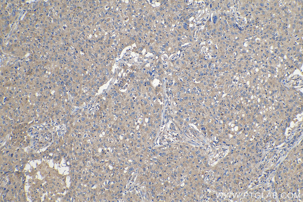 Immunohistochemical analysis of paraffin-embedded human lung cancer tissue slide using KHC1164 (PDK4 IHC Kit).