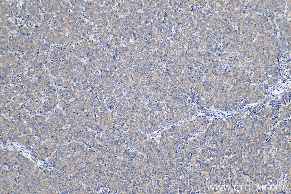 Immunohistochemical analysis of paraffin-embedded human stomach cancer tissue slide using KHC1164 (PDK4 IHC Kit).