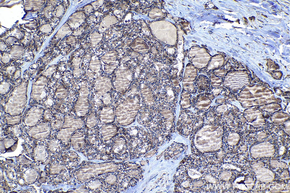 Immunohistochemical analysis of paraffin-embedded human thyroid cancer tissue slide using KHC1282 (PDP1 IHC Kit).