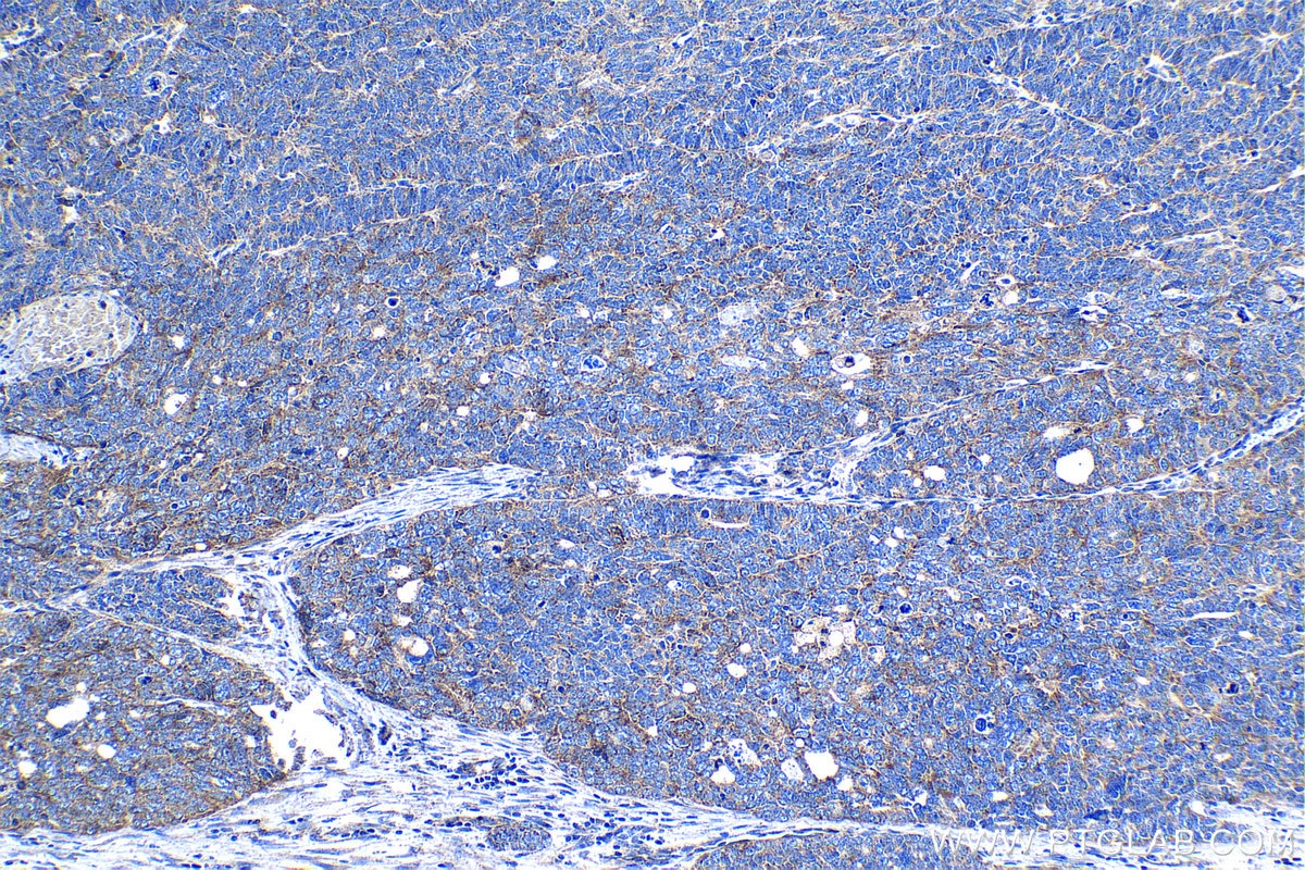 Immunohistochemical analysis of paraffin-embedded human ovary tumor tissue slide using KHC1282 (PDP1 IHC Kit).