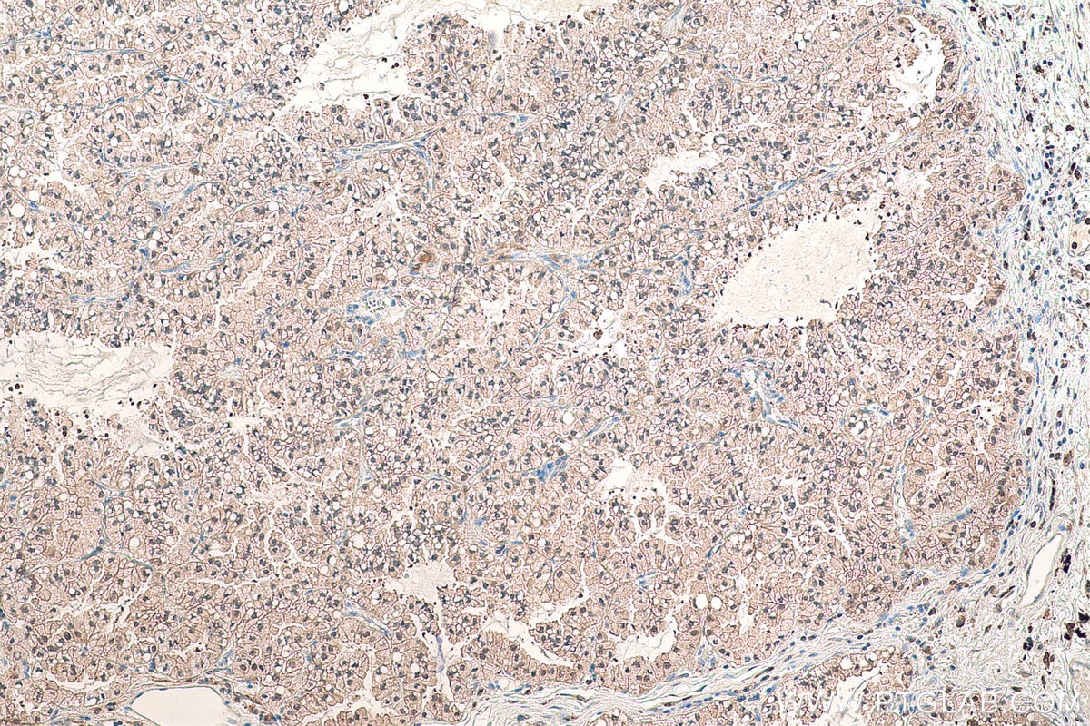 Immunohistochemical analysis of paraffin-embedded human lung cancer tissue slide using KHC0864 (PDXK IHC Kit).