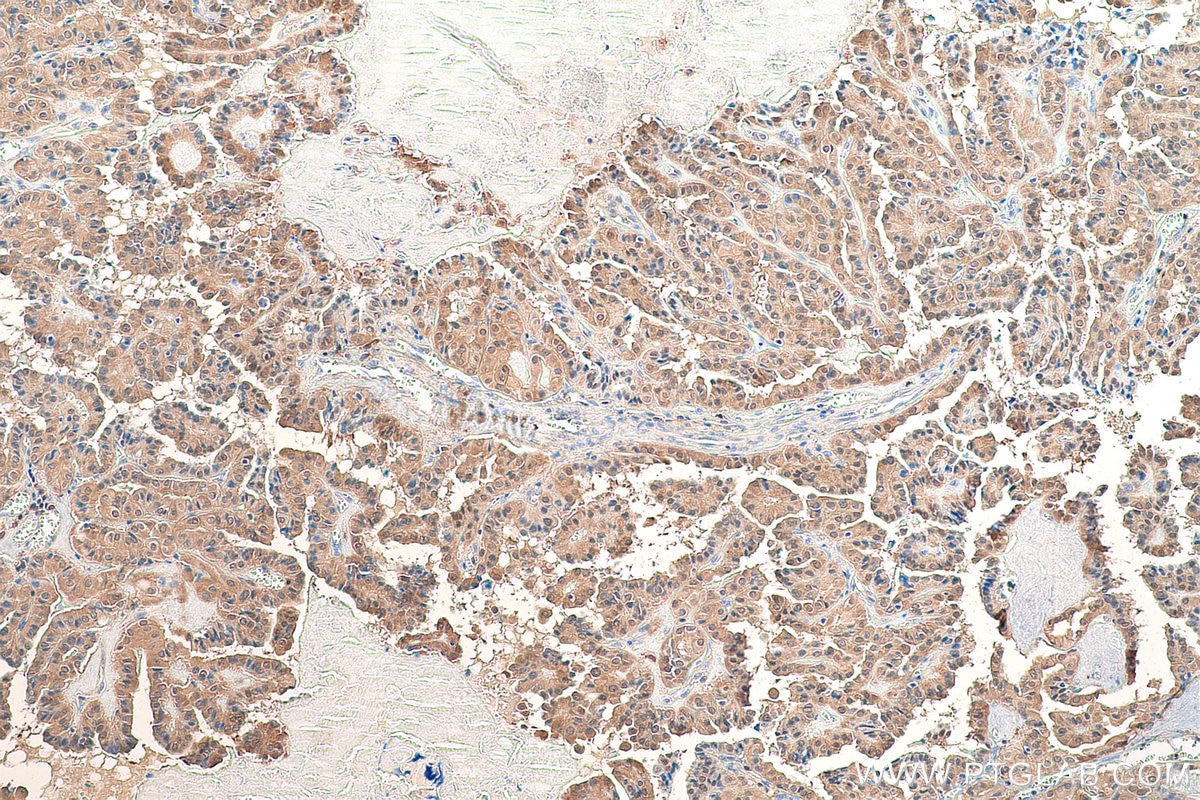Immunohistochemical analysis of paraffin-embedded human thyroid cancer tissue slide using KHC0864 (PDXK IHC Kit).