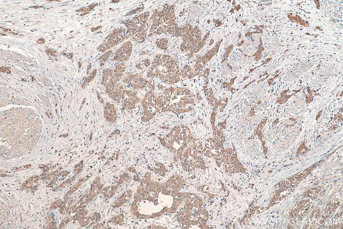 Immunohistochemical analysis of paraffin-embedded human urothelial carcinoma tissue slide using KHC0864 (PDXK IHC Kit).