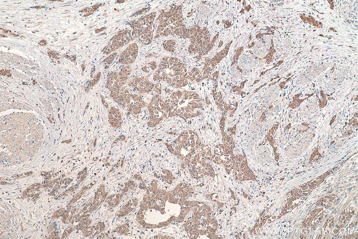 Immunohistochemical analysis of paraffin-embedded human urothelial carcinoma tissue slide using KHC0864 (PDXK IHC Kit).