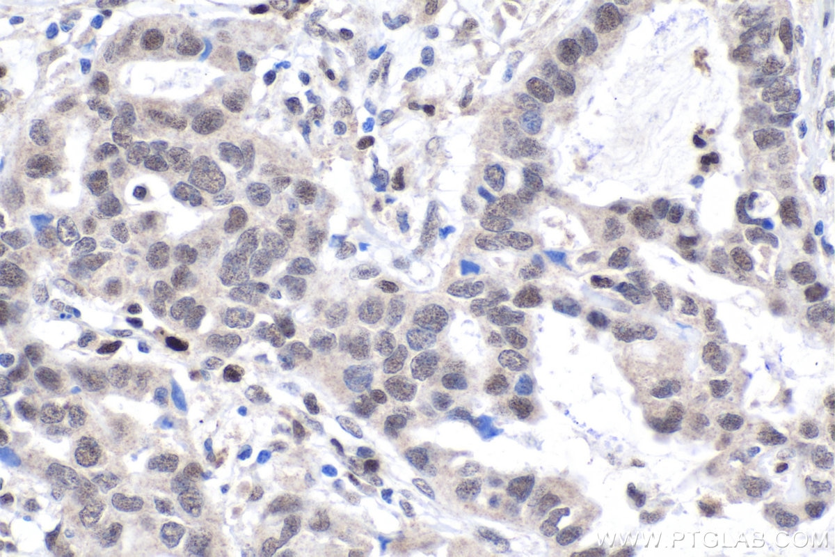 Immunohistochemical analysis of paraffin-embedded human lung cancer tissue slide using KHC1806 (PEG10 IHC Kit).