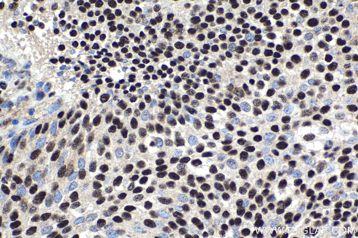 Immunohistochemical analysis of paraffin-embedded human urothelial carcinoma tissue slide using KHC1828 (PELP1 IHC Kit).