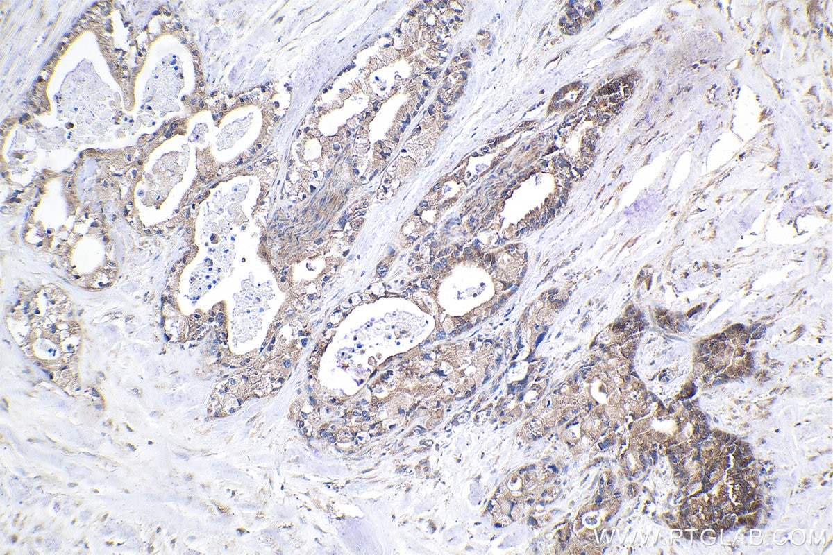 Immunohistochemical analysis of paraffin-embedded human pancreas cancer tissue slide using KHC1959 (PFDN4 IHC Kit).