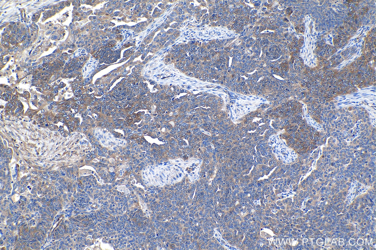 Immunohistochemical analysis of paraffin-embedded human ovary tumor tissue slide using KHC1278 (PFKL IHC Kit).