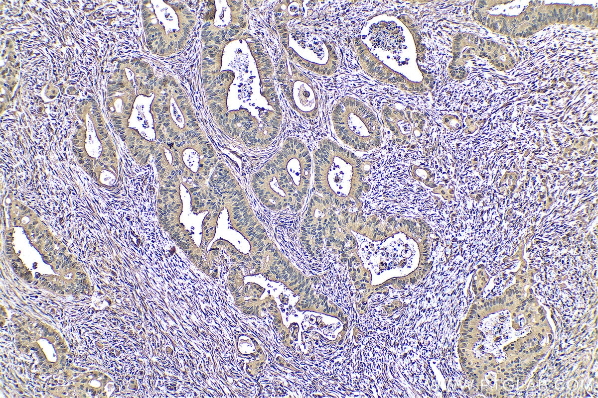 Immunohistochemical analysis of paraffin-embedded human colon cancer tissue slide using KHC0519 (PFN1 IHC Kit).
