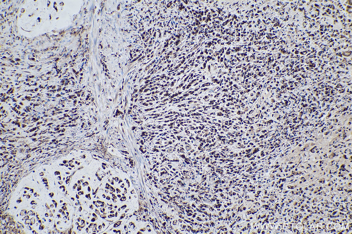 Immunohistochemical analysis of paraffin-embedded human stomach cancer tissue slide using KHC0542 (PGK1 IHC Kit).