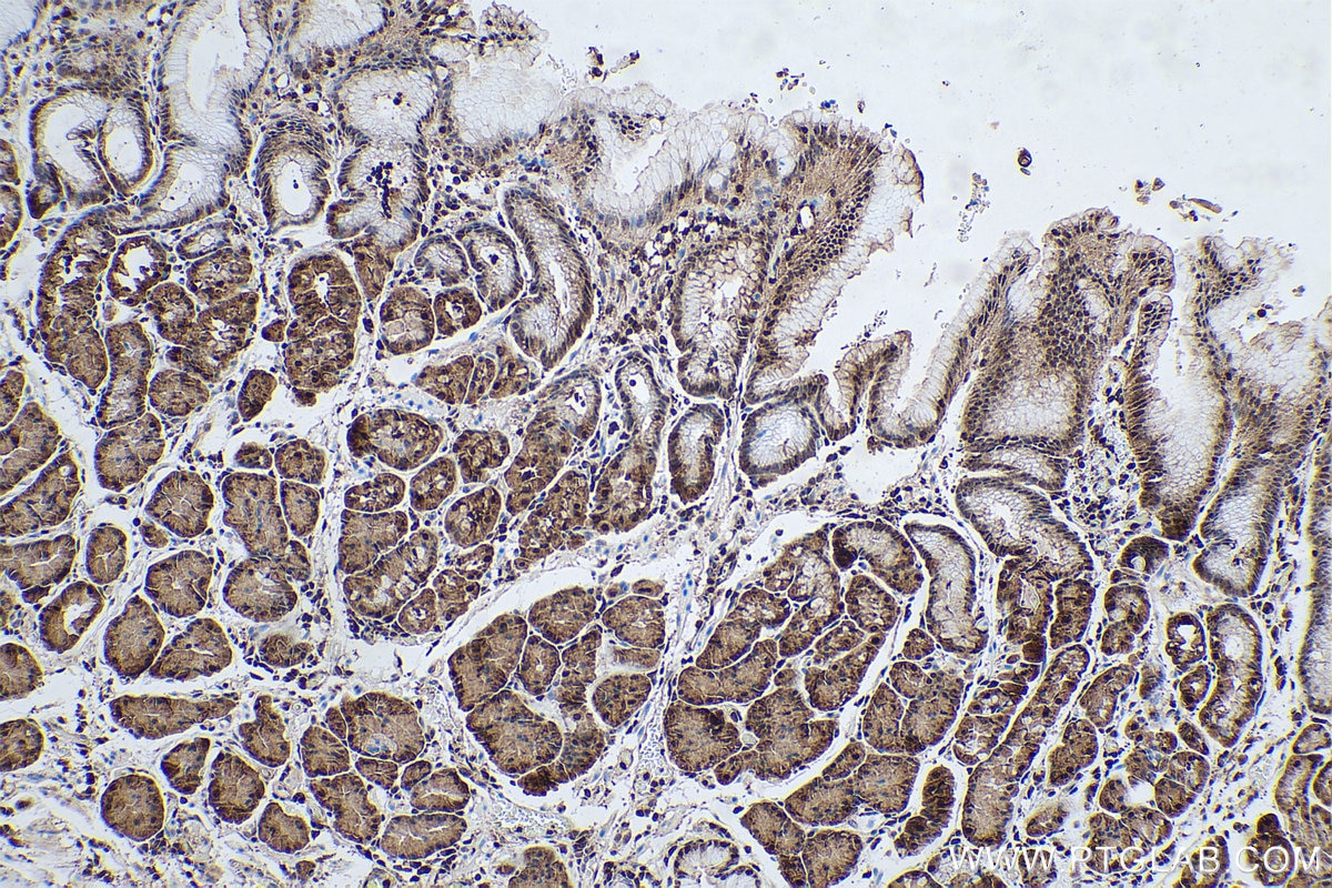 Immunohistochemical analysis of paraffin-embedded human stomach cancer(NAT) tissue slide using KHC0542 (PGK1 IHC Kit).