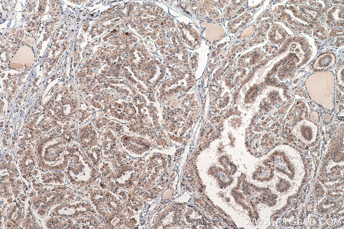 Immunohistochemical analysis of paraffin-embedded human thyroid cancer tissue slide using KHC0567 (PGM1 IHC Kit).