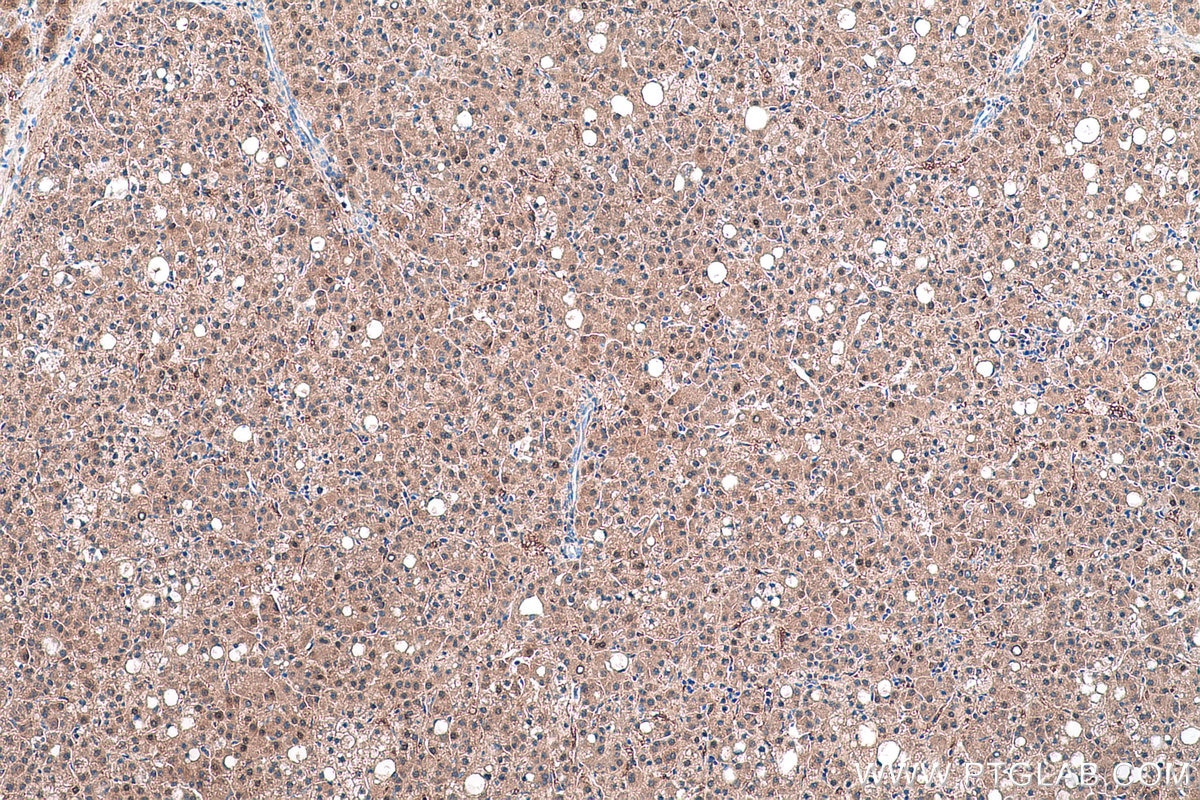 Immunohistochemical analysis of paraffin-embedded human liver cancer tissue slide using KHC0567 (PGM1 IHC Kit).