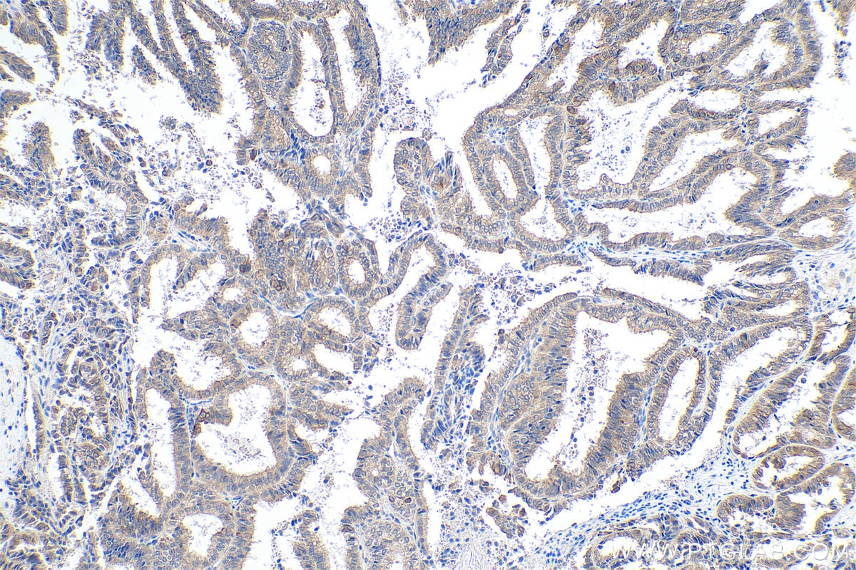 Immunohistochemical analysis of paraffin-embedded human ovary tumor tissue slide using KHC0546 (PGRMC1 IHC Kit).