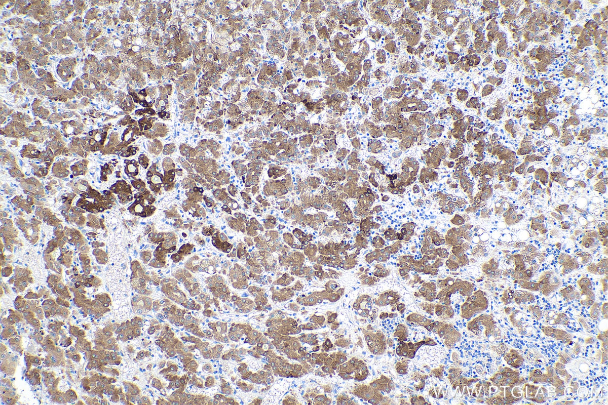 Immunohistochemical analysis of paraffin-embedded human liver cancer tissue slide using KHC0546 (PGRMC1 IHC Kit).
