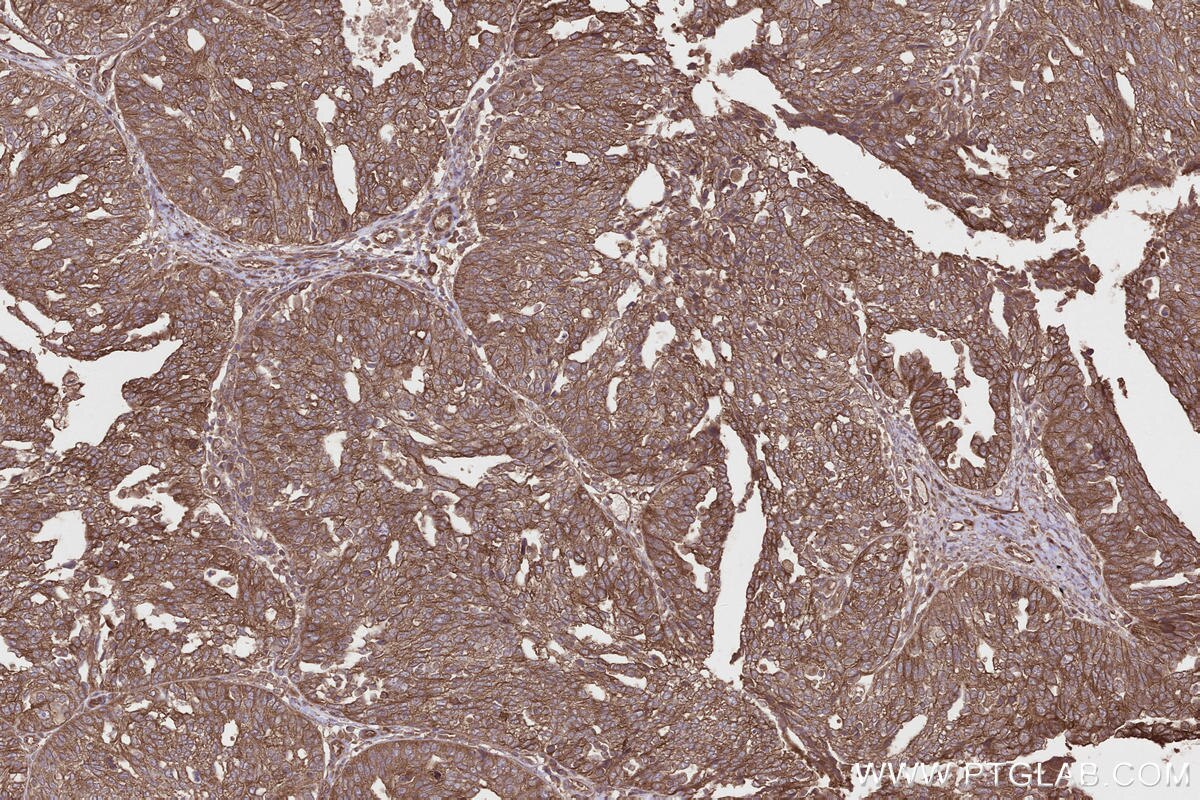 Immunohistochemical analysis of paraffin-embedded human ovary cancer tissue slide using KHC2662 (PHACTR4 IHC Kit).