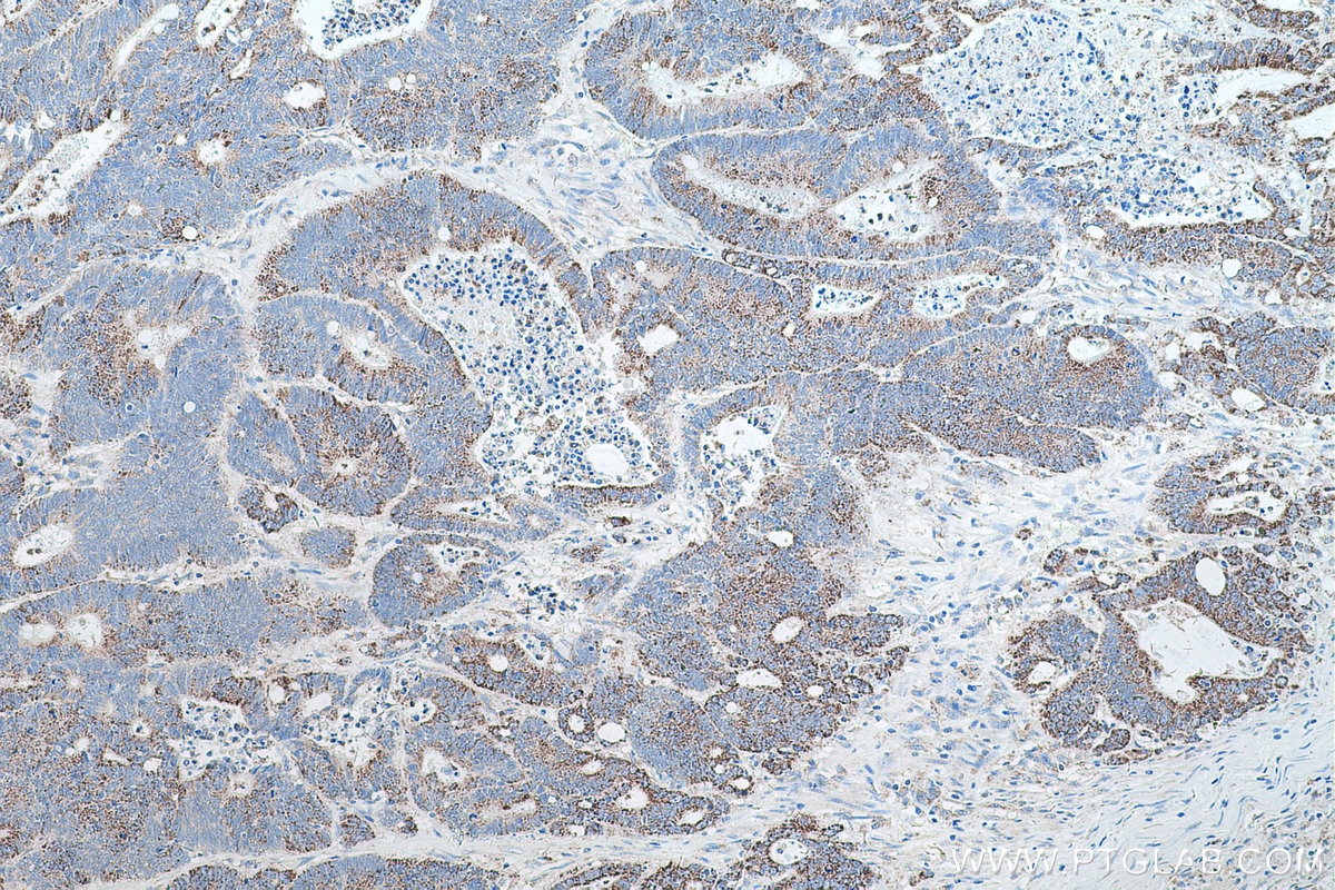 Immunohistochemical analysis of paraffin-embedded human colon cancer tissue slide using KHC0570 (PHB2 IHC Kit).