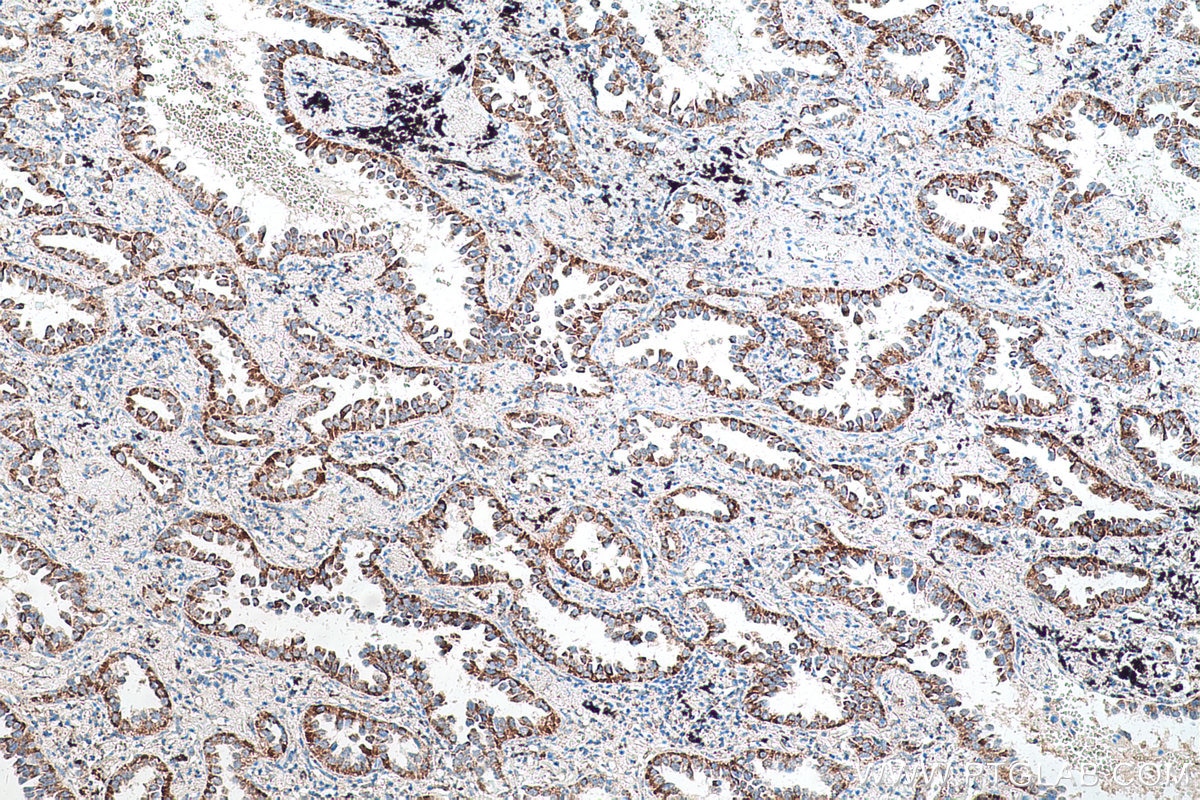 Immunohistochemical analysis of paraffin-embedded human lung cancer tissue slide using KHC0570 (PHB2 IHC Kit).