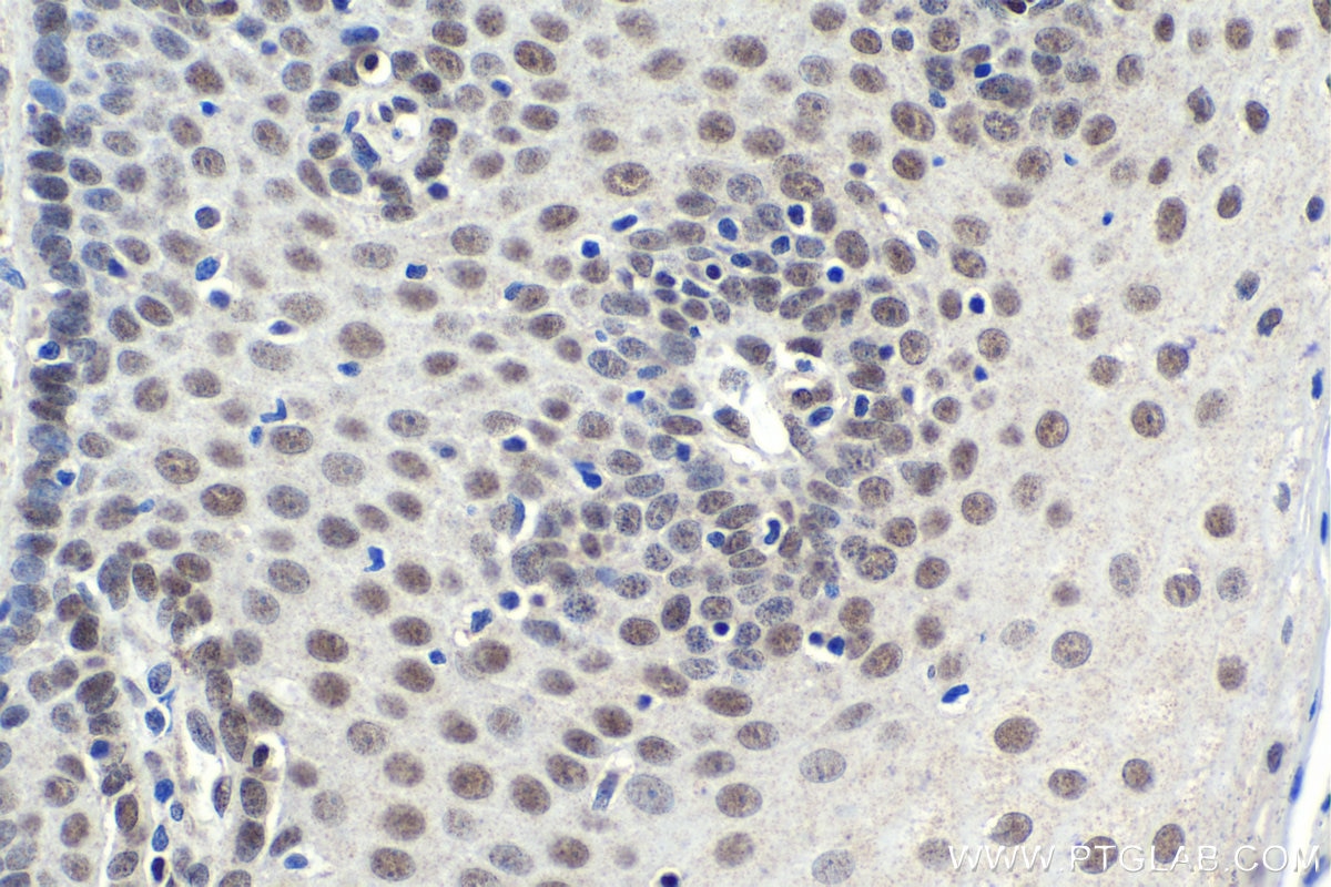 Immunohistochemical analysis of paraffin-embedded human oesophagus cancer tissue slide using KHC1822 (PHC2 IHC Kit).