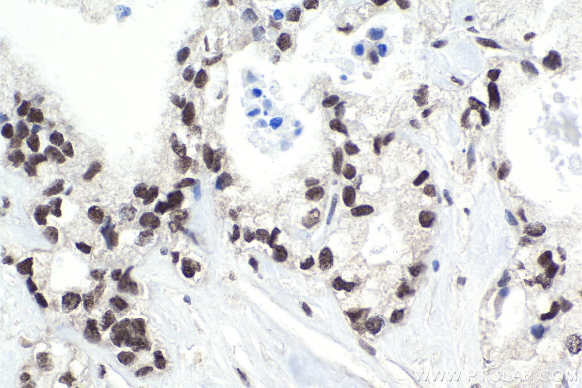 Immunohistochemical analysis of paraffin-embedded human pancreas cancer tissue slide using KHC1822 (PHC2 IHC Kit).