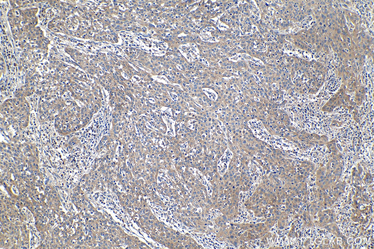 Immunohistochemical analysis of paraffin-embedded human cervical cancer tissue slide using KHC1225 (PHD2/EGLN1 IHC Kit).