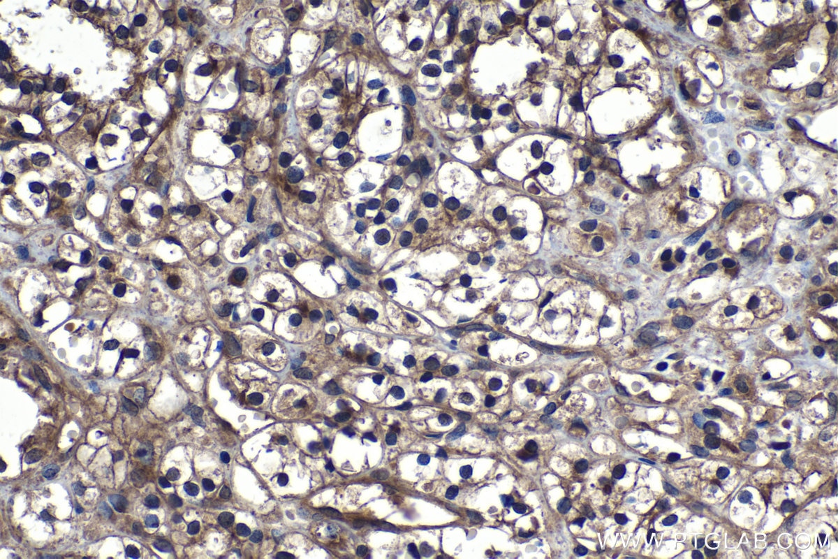 Immunohistochemical analysis of paraffin-embedded human renal cell carcinoma tissue slide using KHC1225 (PHD2/EGLN1 IHC Kit).