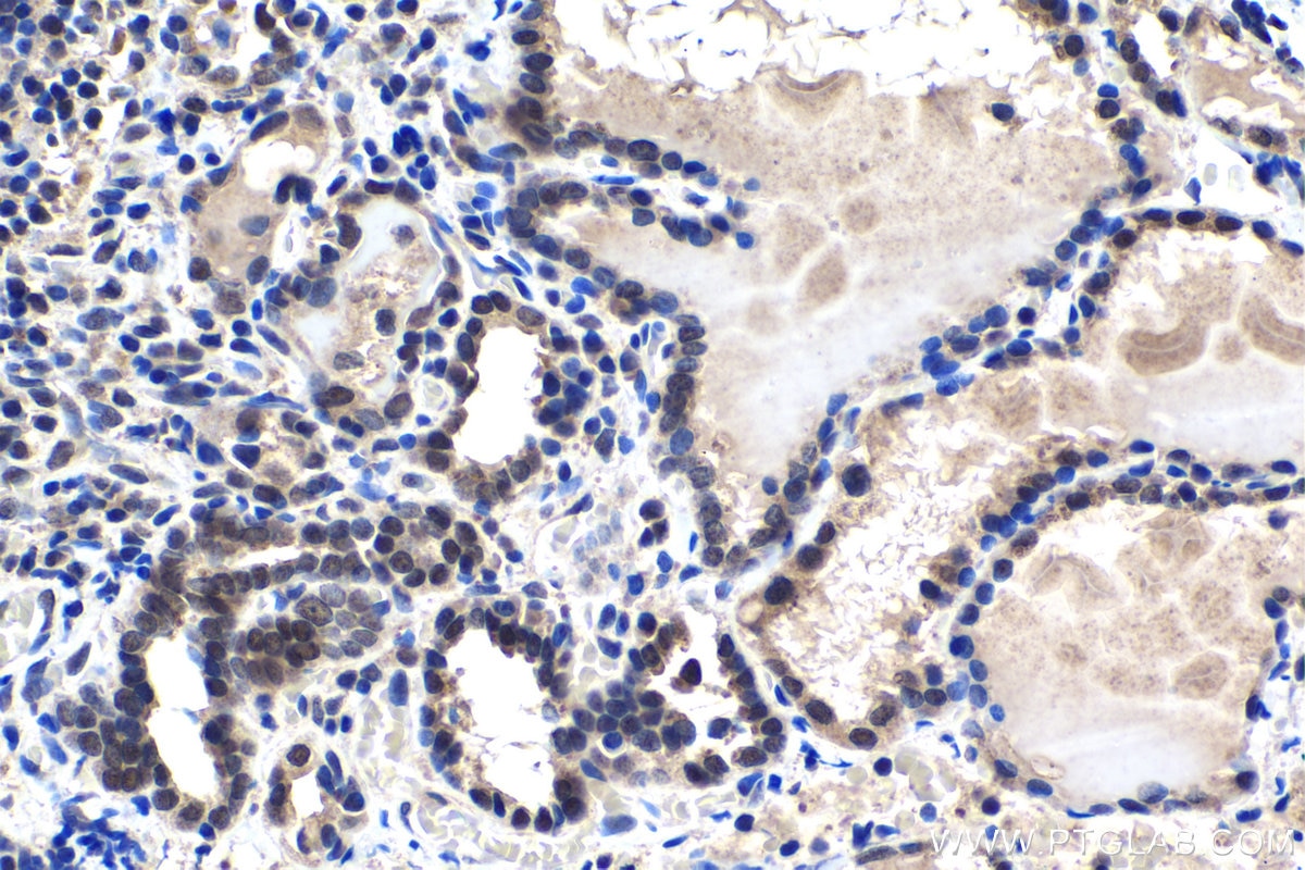 Immunohistochemical analysis of paraffin-embedded human thyroid cancer tissue slide using KHC1487 (PHF14 IHC Kit).