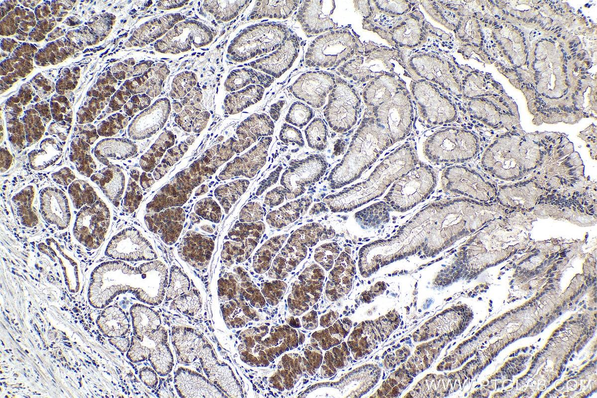 Immunohistochemical analysis of paraffin-embedded human stomach cancer tissue slide using KHC1487 (PHF14 IHC Kit).