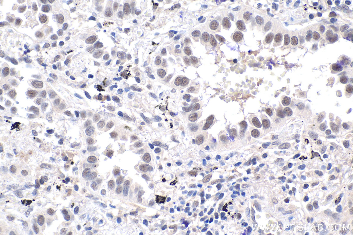 Immunohistochemical analysis of paraffin-embedded human lung cancer tissue slide using KHC1800 (PHF5A IHC Kit).