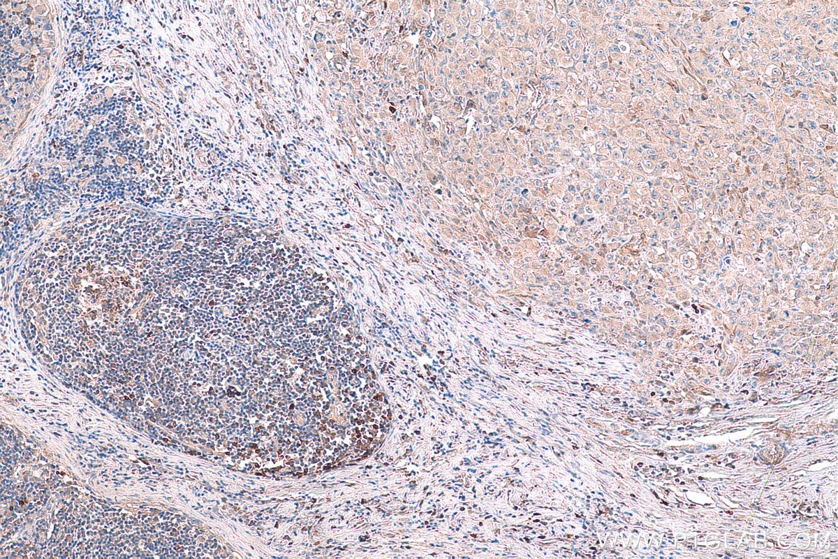 Immunohistochemical analysis of paraffin-embedded human lymphoma tissue slide using KHC0839 (PHGDH IHC Kit).