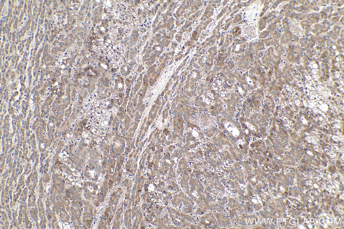 Immunohistochemical analysis of paraffin-embedded human liver cancer tissue slide using KHC0310 (PI16 IHC Kit).