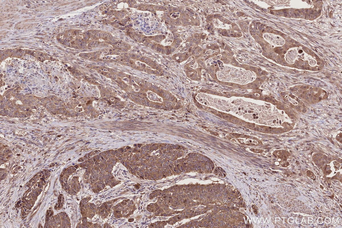 Immunohistochemical analysis of paraffin-embedded human stomach cancer tissue slide using KHC2742 (PIBF1 IHC Kit).