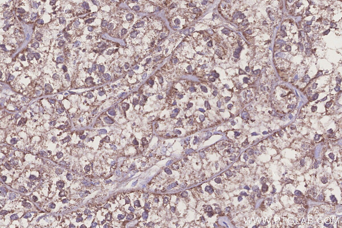 Immunohistochemical analysis of paraffin-embedded human renal cell carcinoma tissue slide using KHC3234 (PIGP IHC Kit). Immunohistochemical analysis of paraffin-embedded human renal cell carcinoma tissue slide using KHC3234 (PIGP IHC Kit).