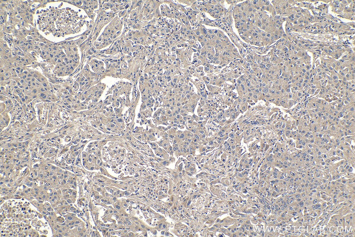 Immunohistochemical analysis of paraffin-embedded human lung cancer tissue slide using KHC1059 (PIK3CA IHC Kit).