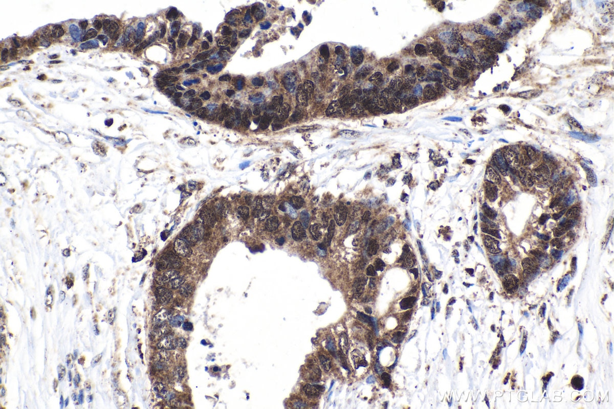 Immunohistochemical analysis of paraffin-embedded human urothelial carcinoma tissue slide using KHC1524 (PIM1 IHC Kit).