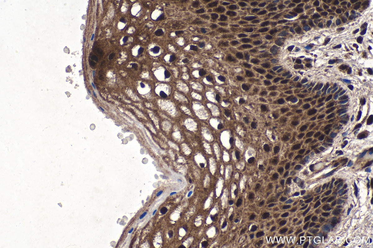 Immunohistochemical analysis of paraffin-embedded human cervical cancer tissue slide using KHC1524 (PIM1 IHC Kit).