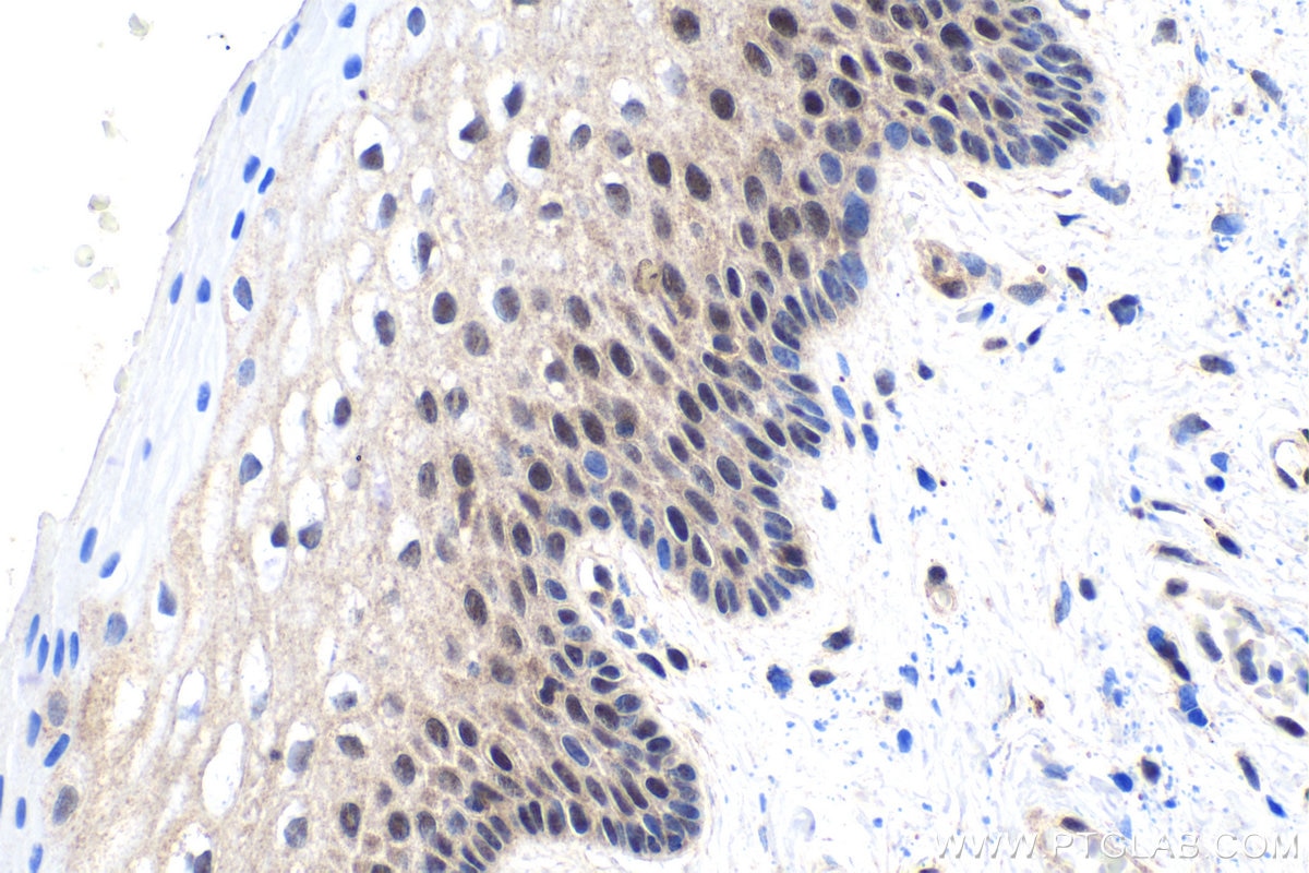 Immunohistochemical analysis of paraffin-embedded human cervical cancer tissue slide using KHC1716 (PIN1 IHC Kit).