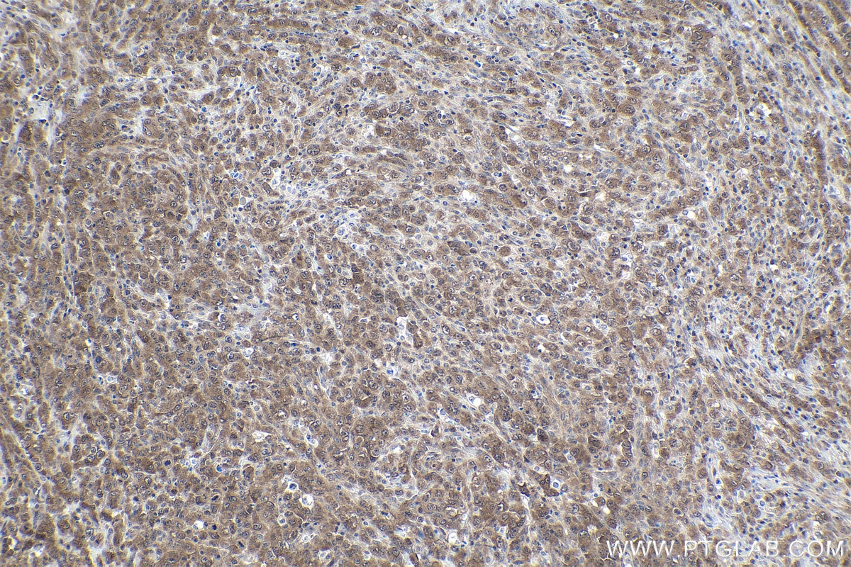Immunohistochemical analysis of paraffin-embedded human lymphoma tissue slide using KHC1716 (PIN1 IHC Kit).